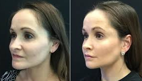 Fat Grafting Cost In Lahore