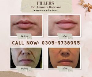 Fillers - Dr. Ammara Rabbani