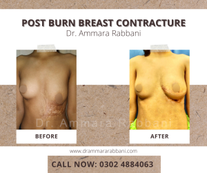 Post Burn Breast Contracture