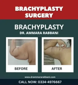 Brachyplasty Surgery