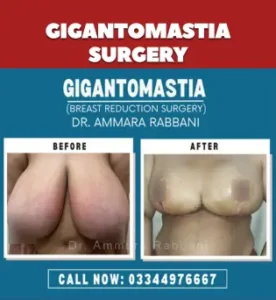 GIGANTOMASTIA SURGERY