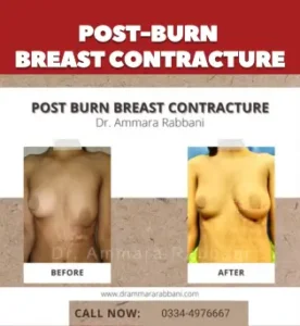 Post-burn breast contracture
