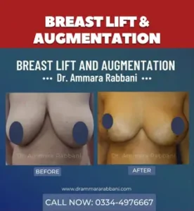 breast Lift and Augmentation