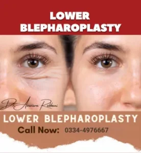 lower blepharoplasty