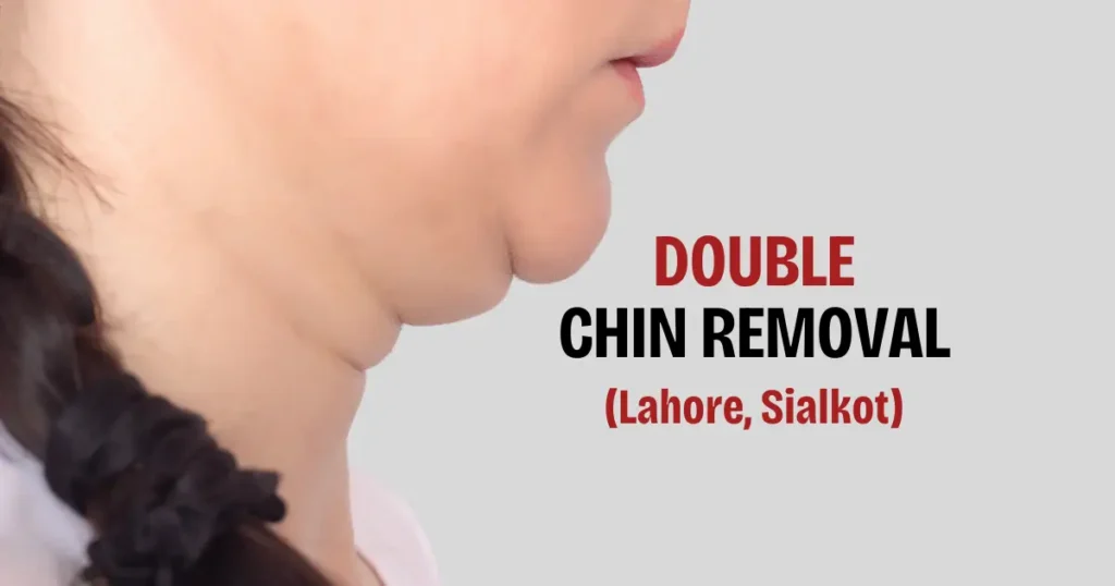 Double Chin Surgery in Sialkot