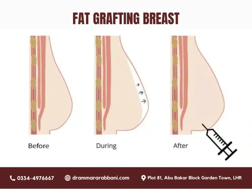 Fat Grafting Breast
