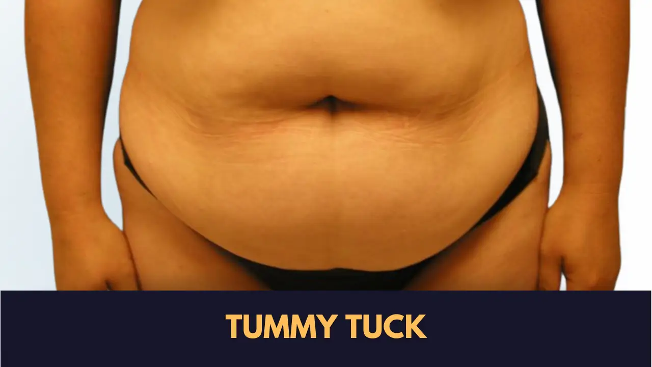 Best Tummy Tuck Surgeon