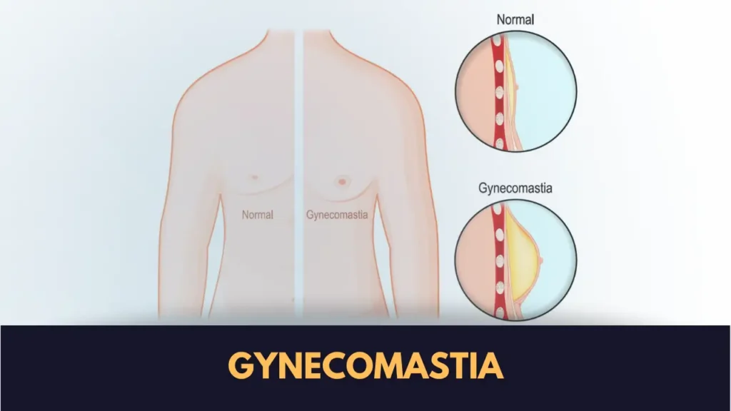 Gynecomastia Surgery Near Me