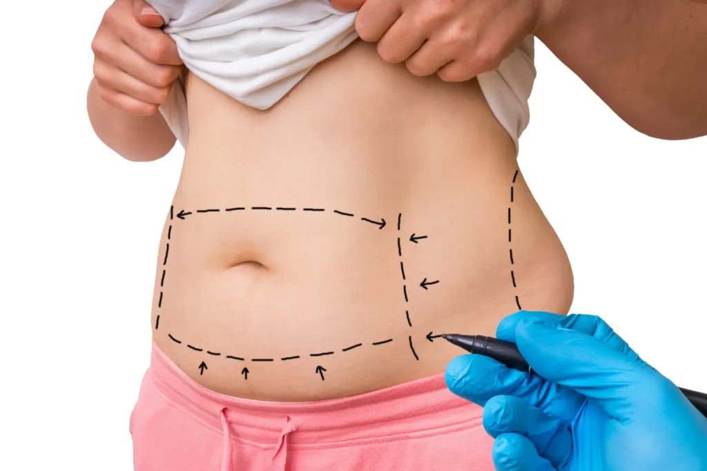 Liposuction before after Lahore