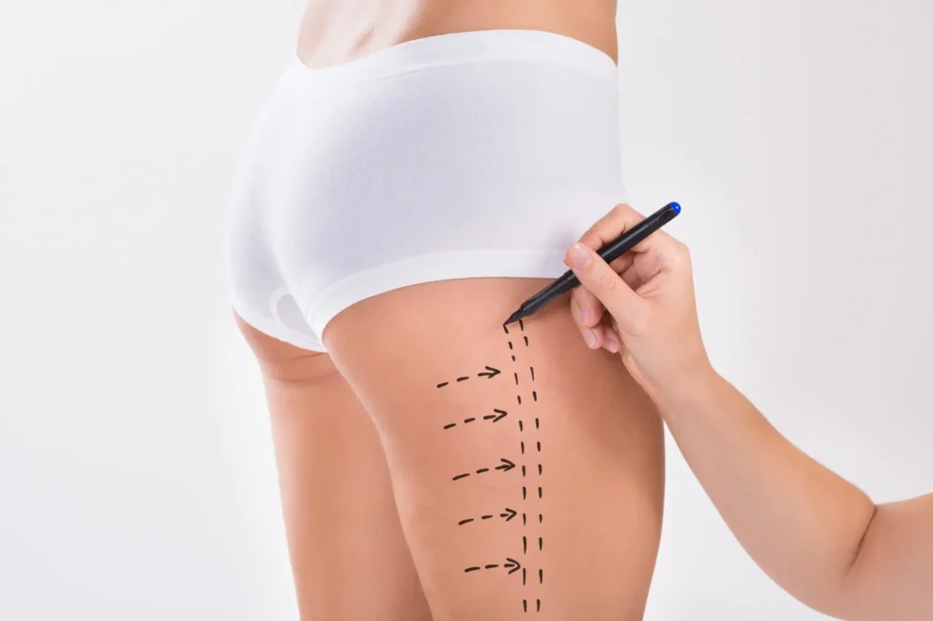 Liposuction near Johar Town Lahore