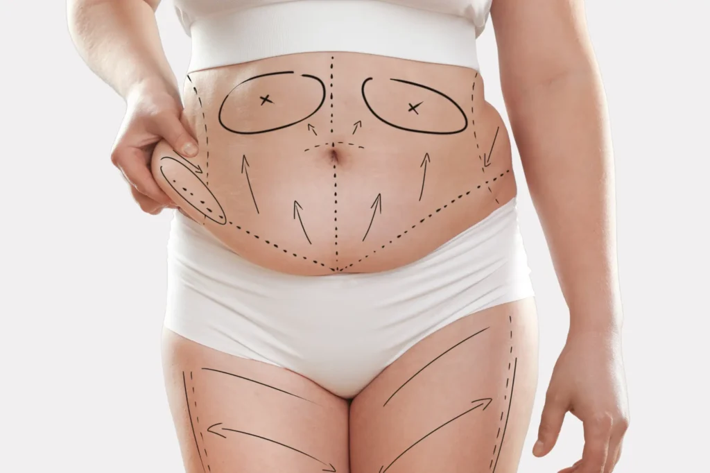 abdominoplasty surgery cost