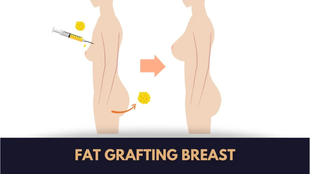affordable breast fat grafting