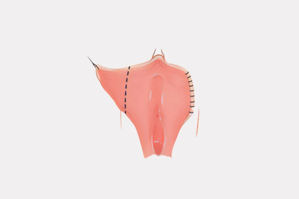 Affordable Labiaplasty Lahore