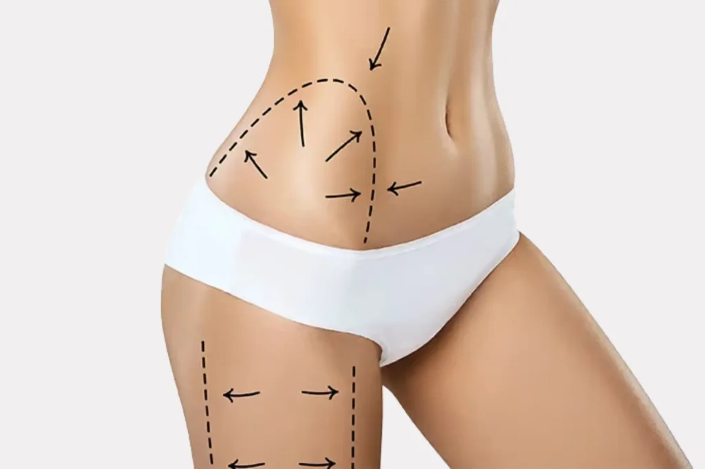 Affordable Vaser Liposuction Pakistan