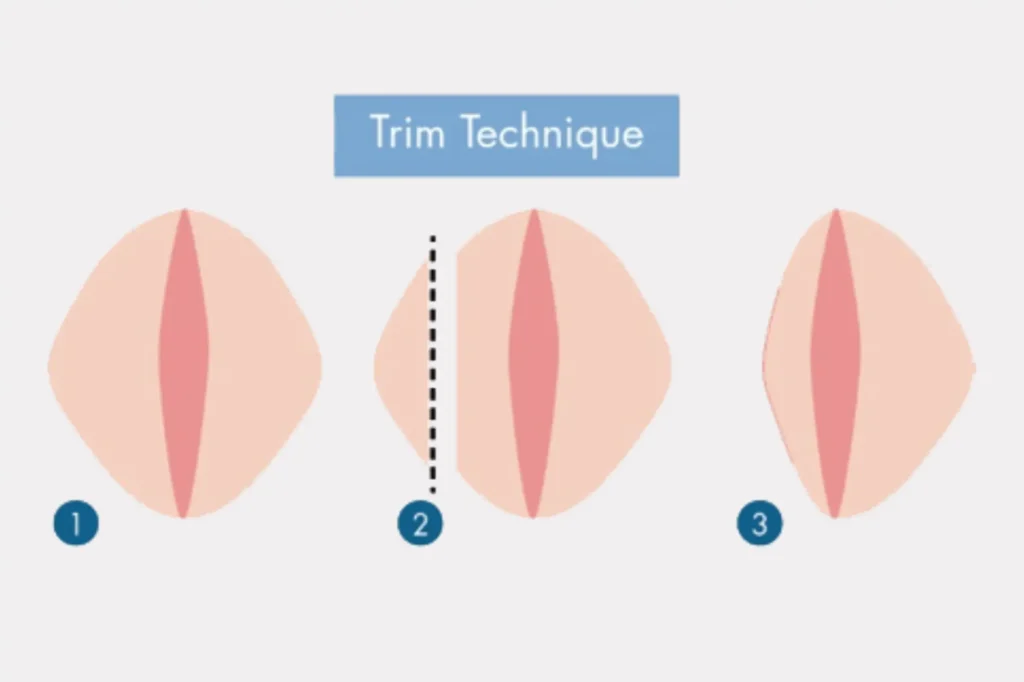 Best Labiaplasty Surgeon in Lahore