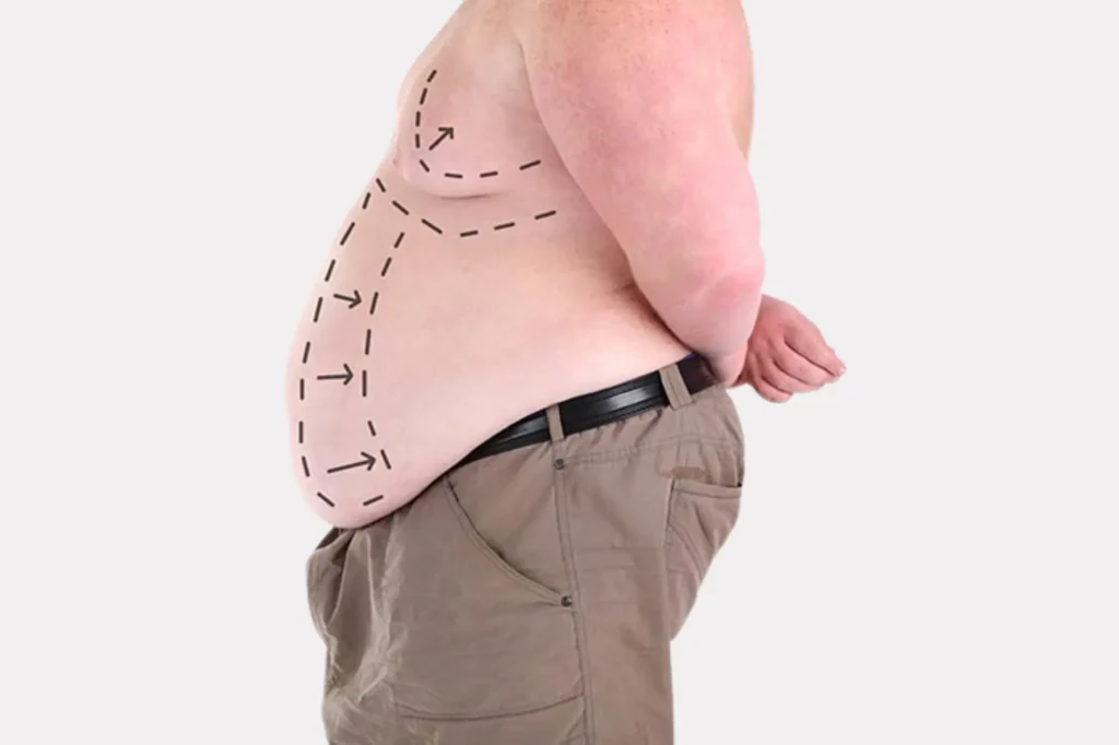 best tummy tuck surgeon Pakistan