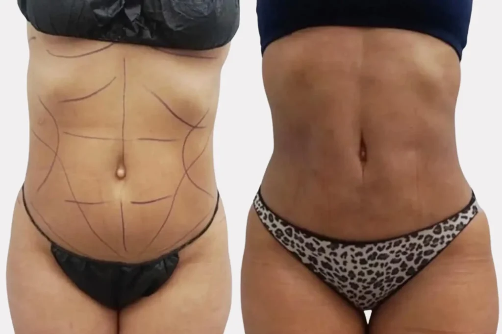 Vaser Liposuction in Lahore