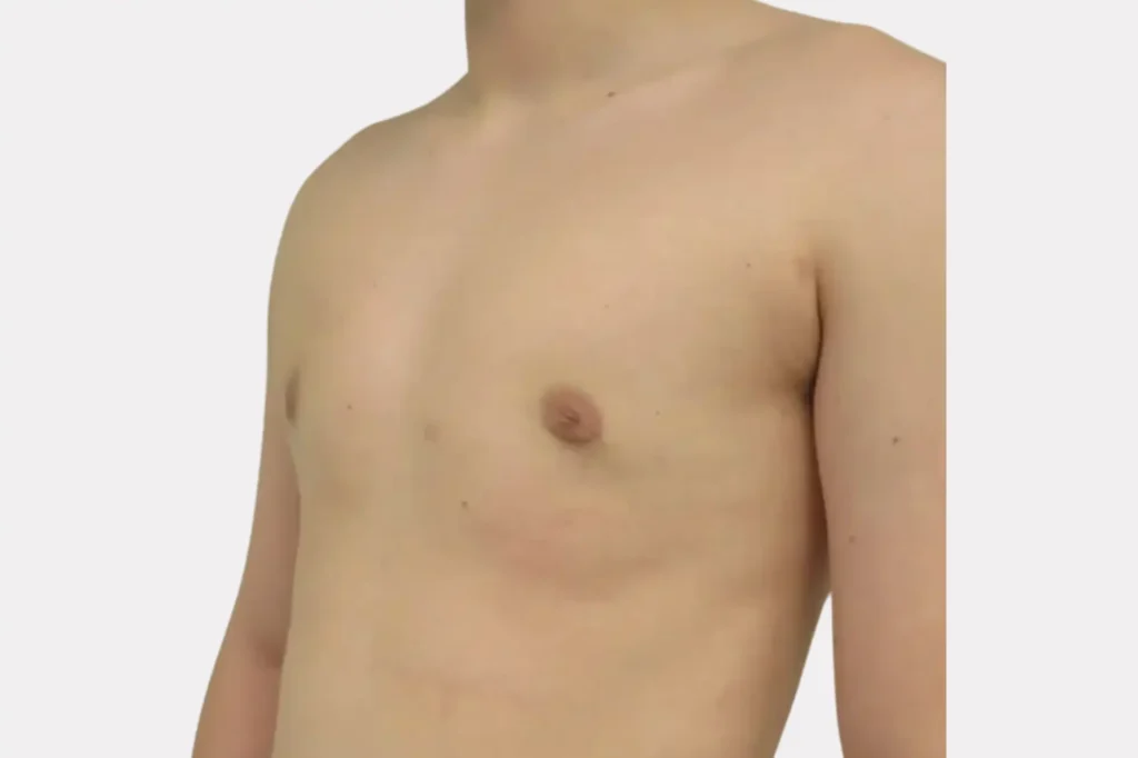 gynecomastia before after lahore