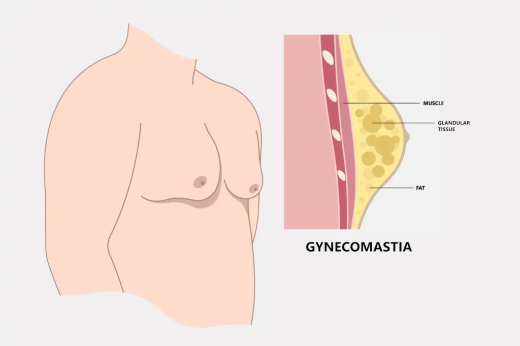 gynecomastia consultation lahore
