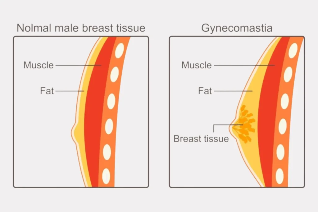 gynecomastia surgery procedure lahore