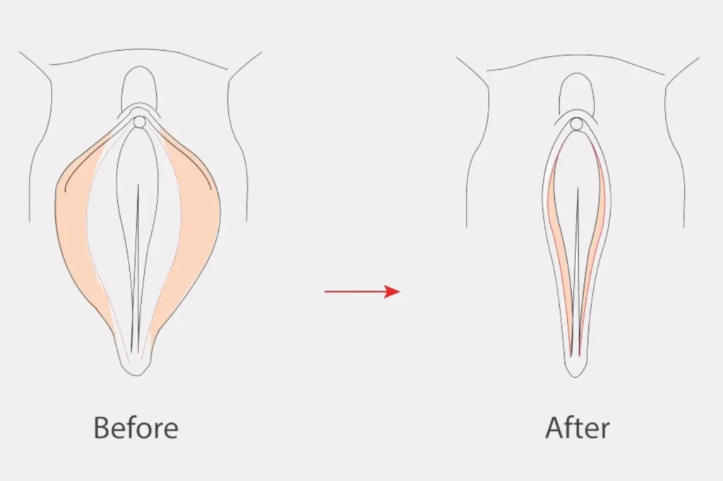 Labiaplasty Before and After Lahore