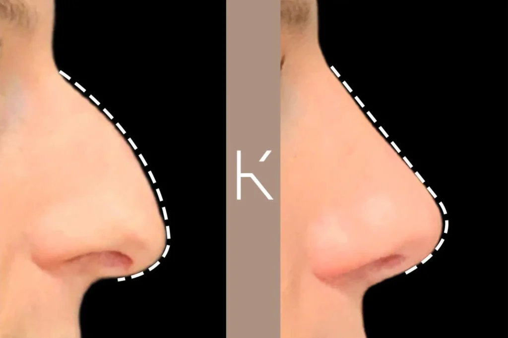 nose job surgery dr ammara rabbani