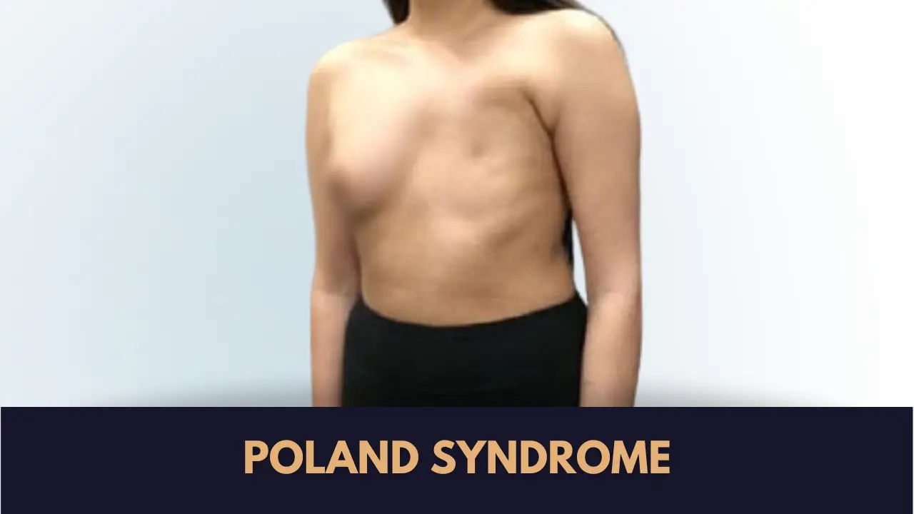 poland syndrome in sialkot