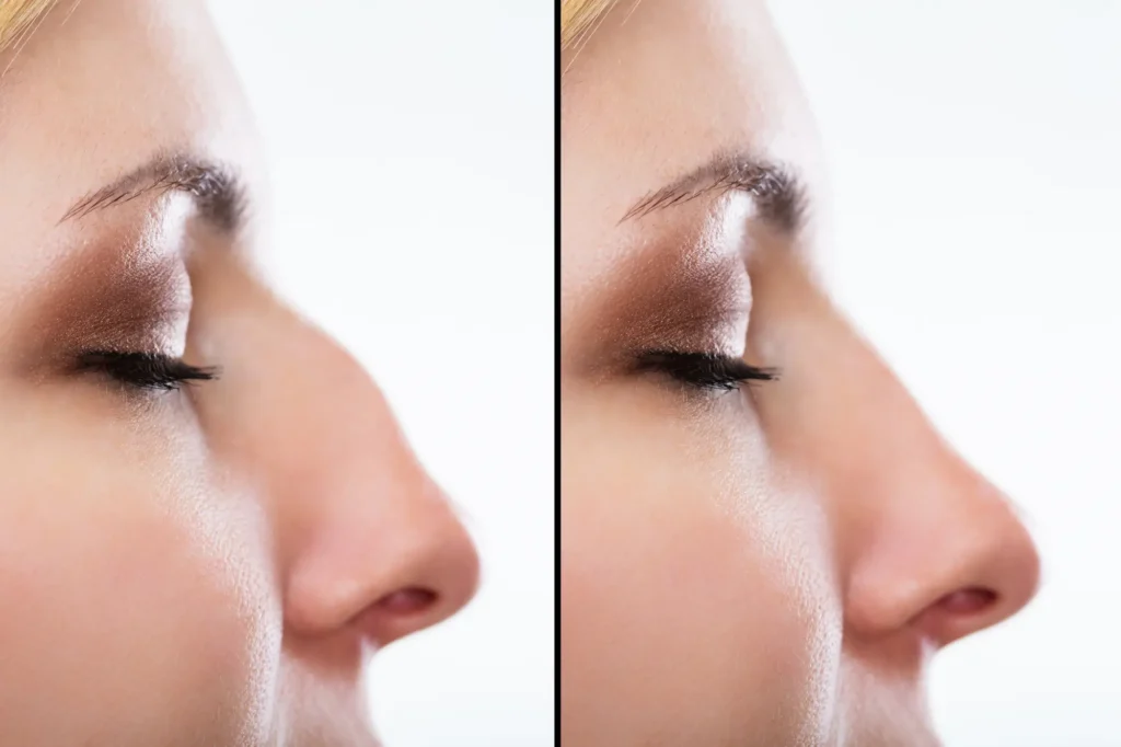 rhinoplasty clinic lahore