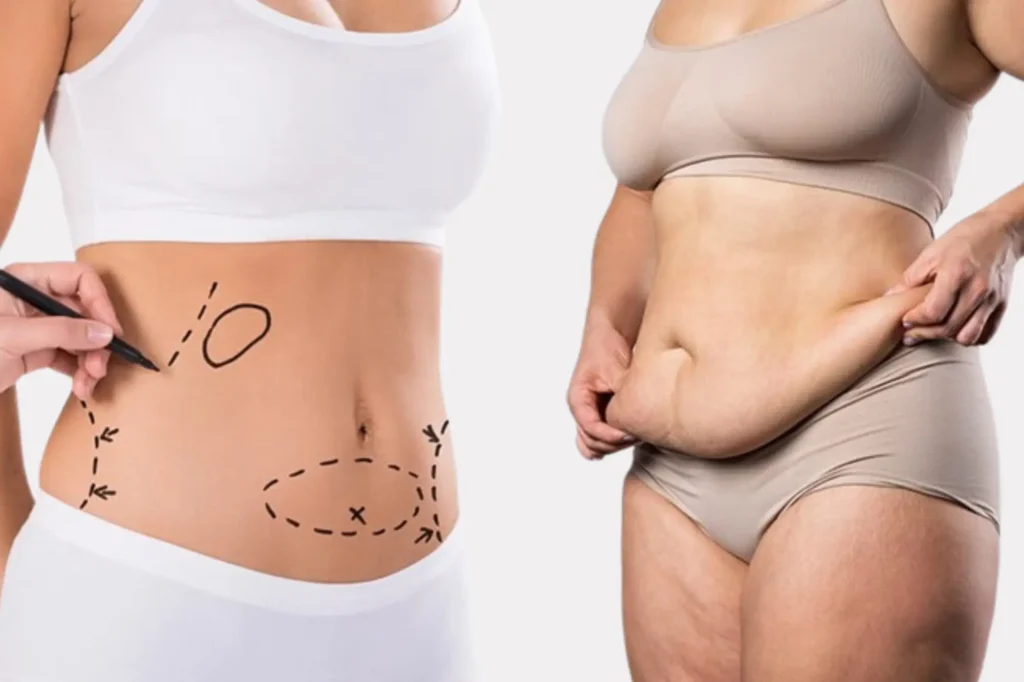 tummy tuck surgery cost