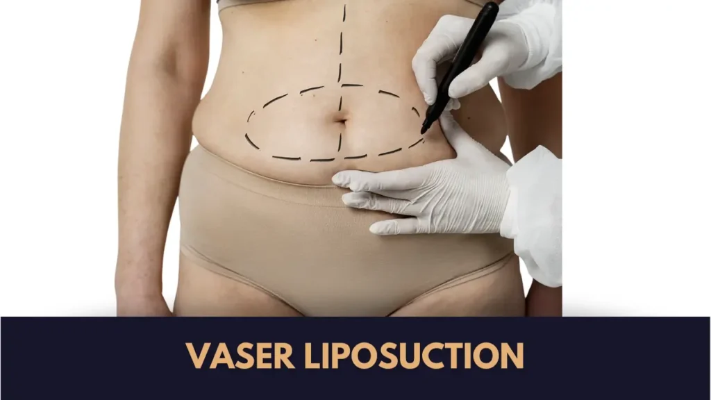Vaser Liposuction Lahore