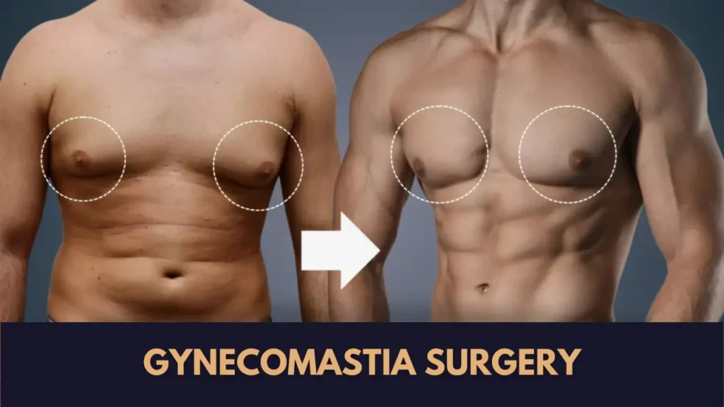 affordable gynecomastia surgery cost in Sialkot