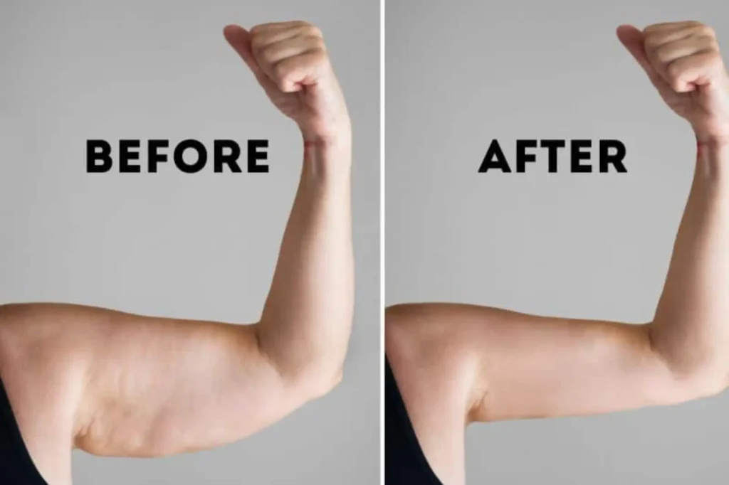 arm lift surgery Lahore cost