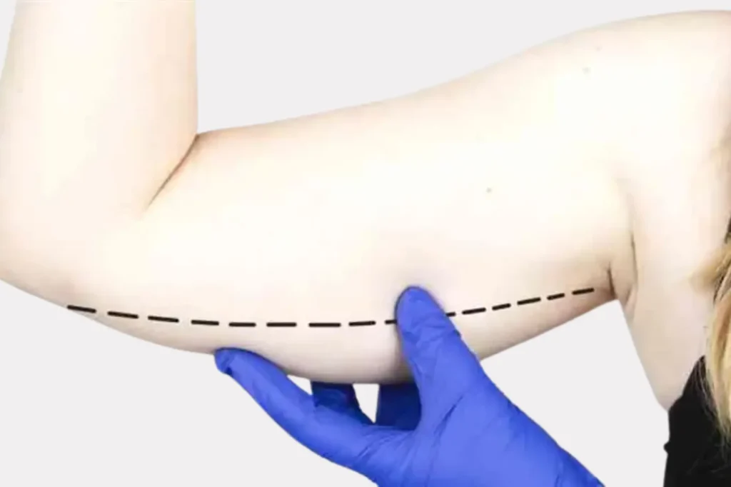 arm lift surgery near DHA Lahore