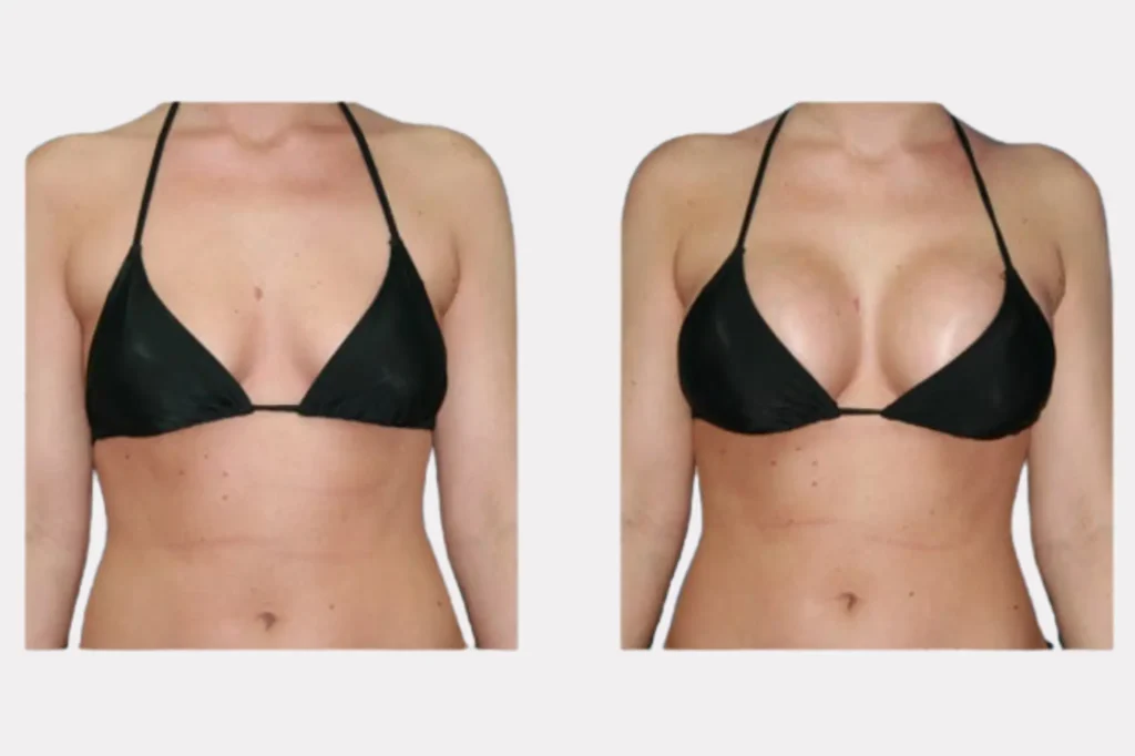 best breast implant surgeon lahore