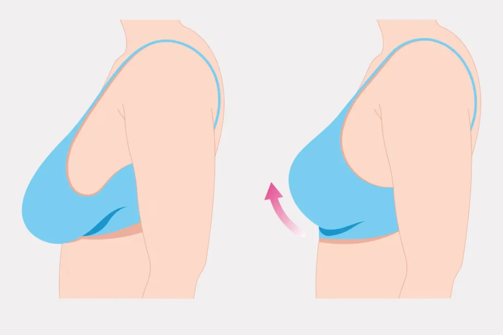 best breast lift surgery in Pakistan