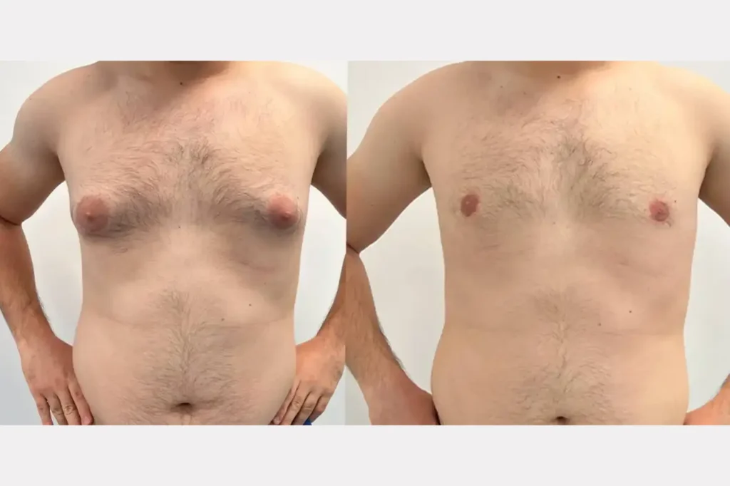 best gynecomastia surgeon