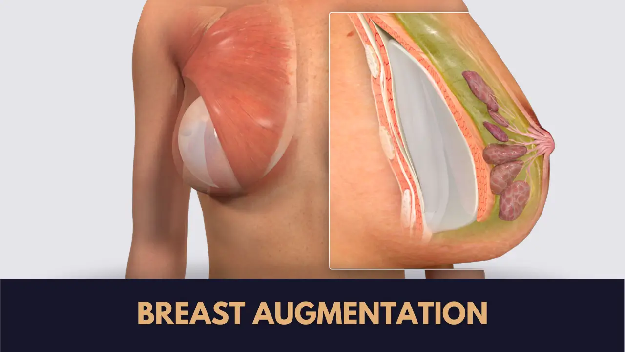 breast augmentation surgery by implant