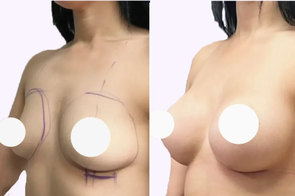 breast augmentation surgery cost
