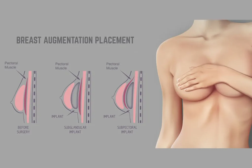 breast implant surgery cost sialkot