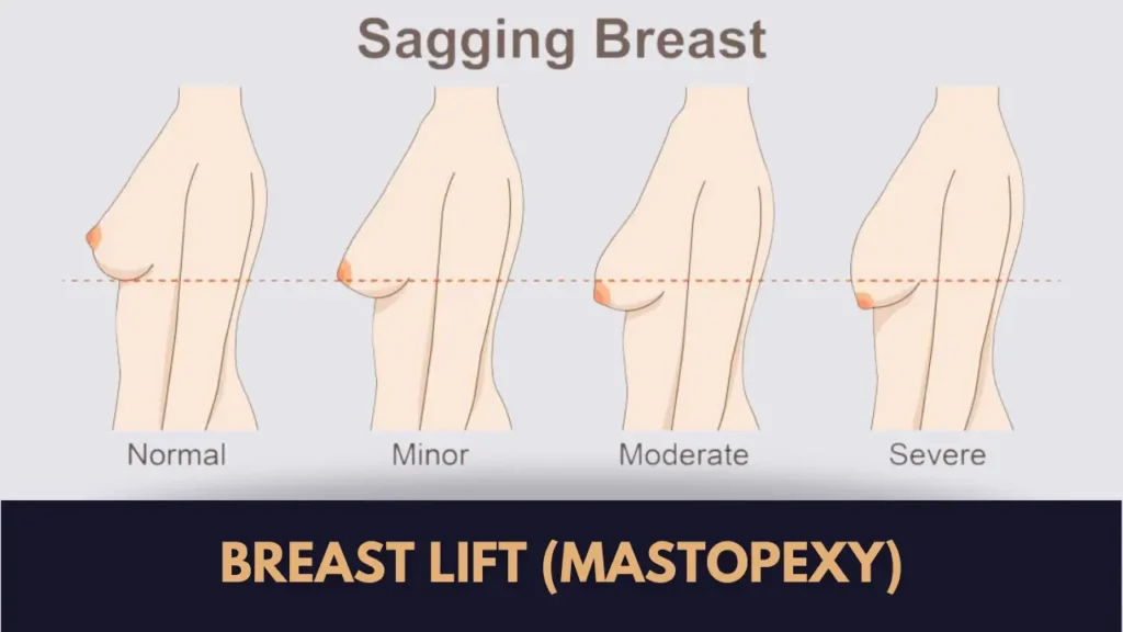 breast lift surgery johar town