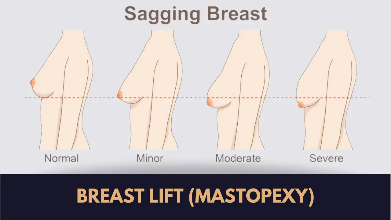 breast lift surgery johar town
