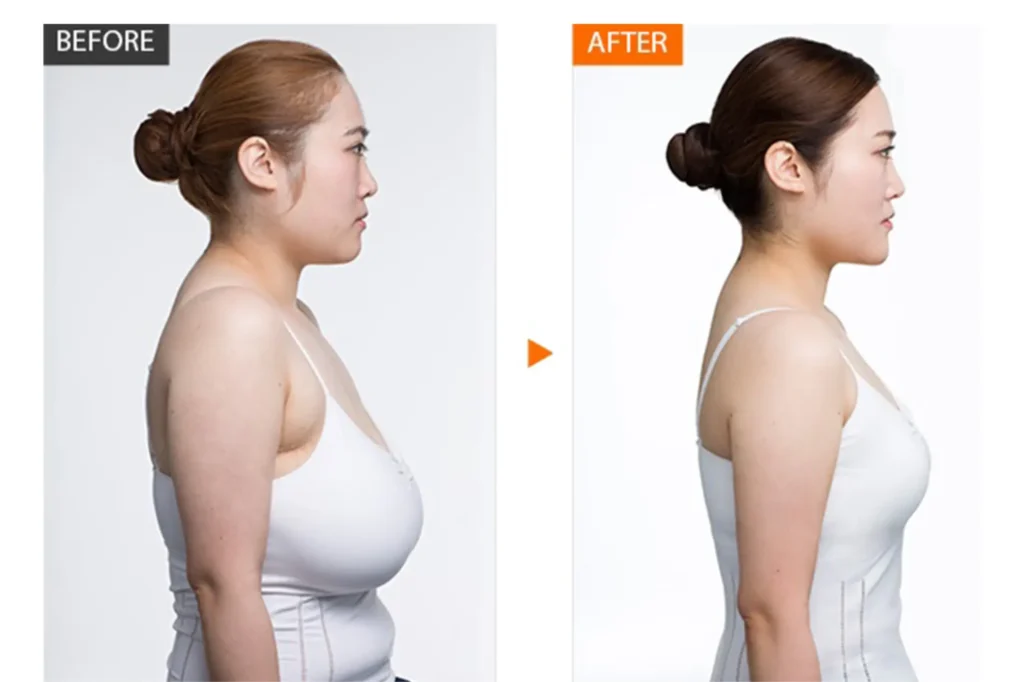 breast reduction johar town