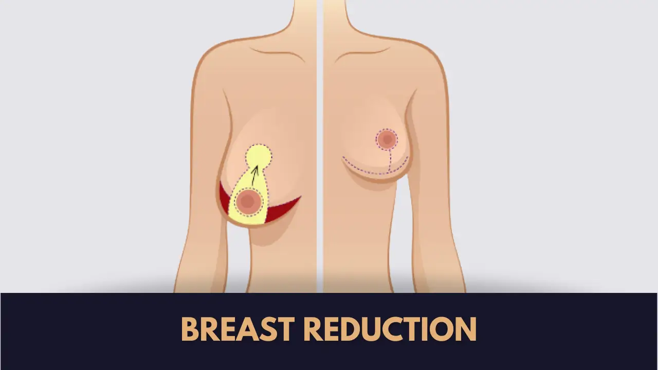 breast reduction surgery pakistan