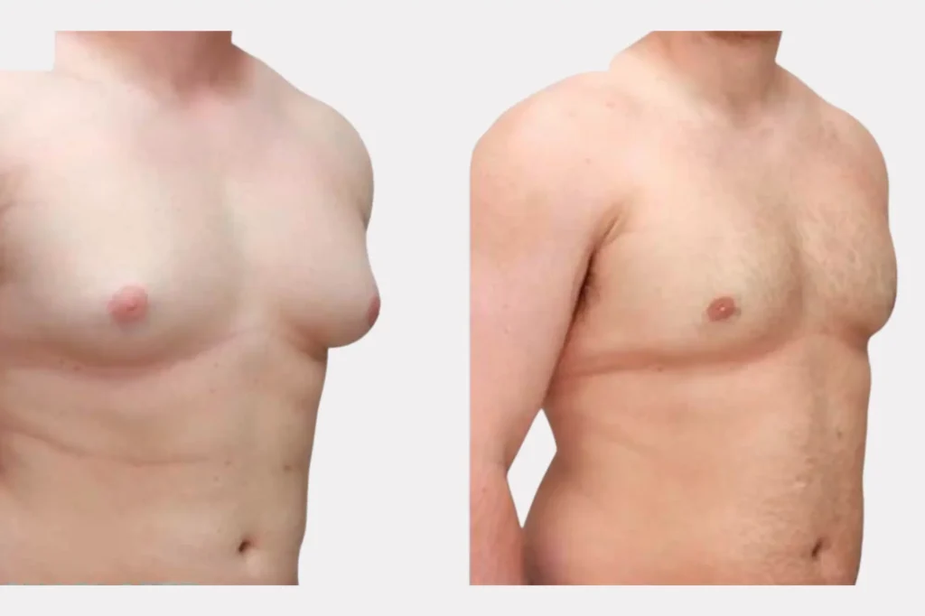 gynecomastia surgery