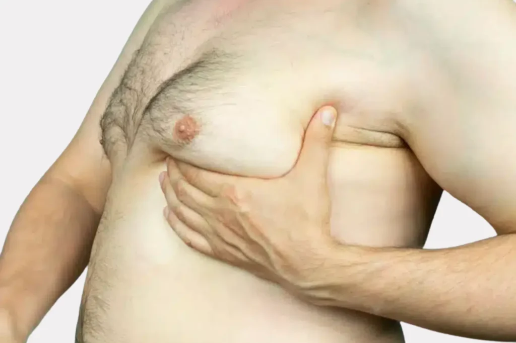 male breast reduction surgery results Lahore