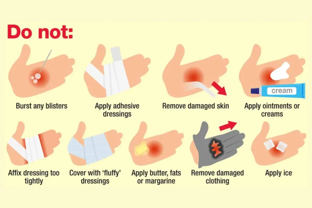 burn treatment Sialkot
