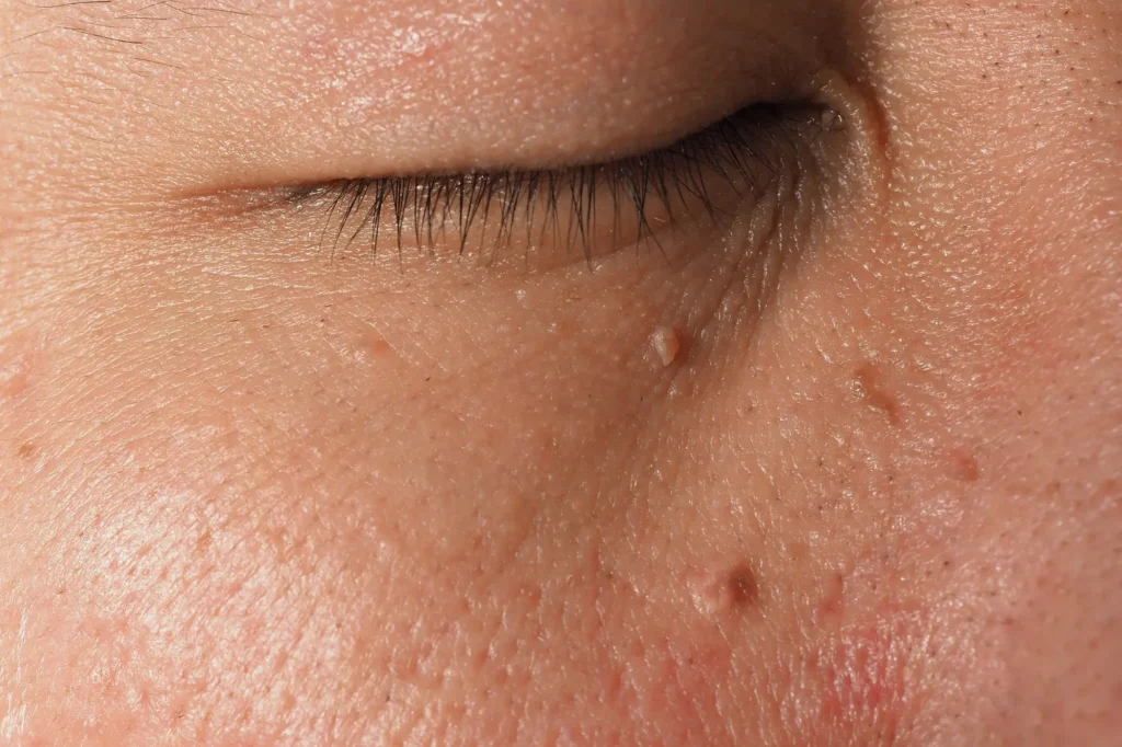 eye bag removal Lahore