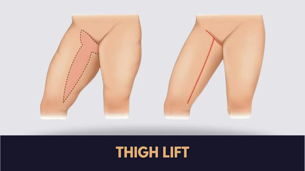 thigh lift cost in Lahore