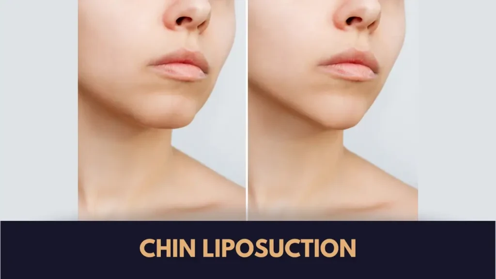 Chin liposuction in Lahore