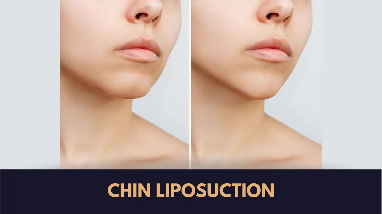 Chin liposuction in Lahore